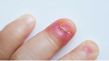 Often Operated, Here Are 5 Natural Ways To Treat Cantengan Nails